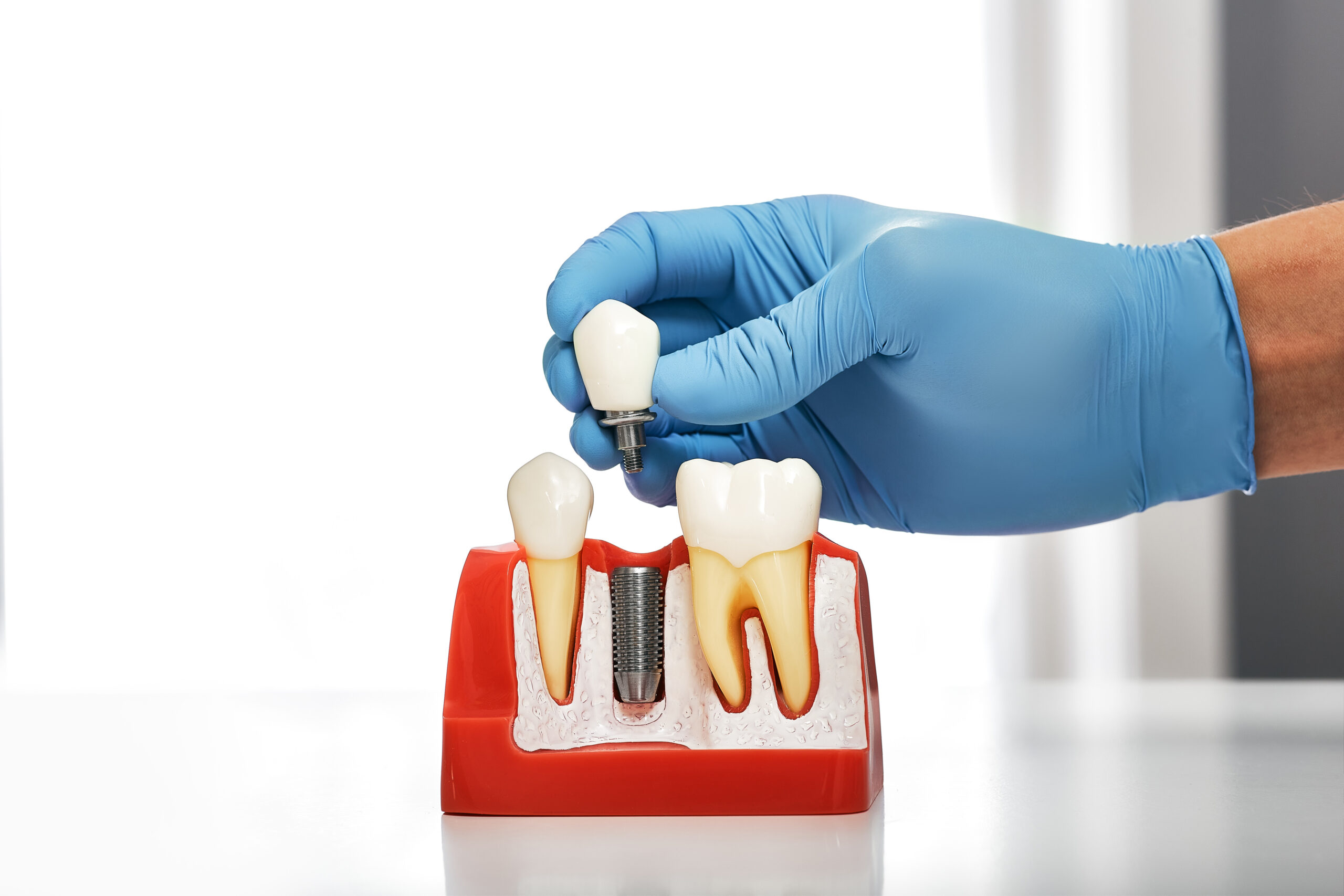 Dentist showing the installation of a dental implant on the anatomical model of teeth, close-up. Process of installing a dental implant Dentist showing the installation of a dental implant on the anatomical model of teeth, close-up. Process of installing a dental implant