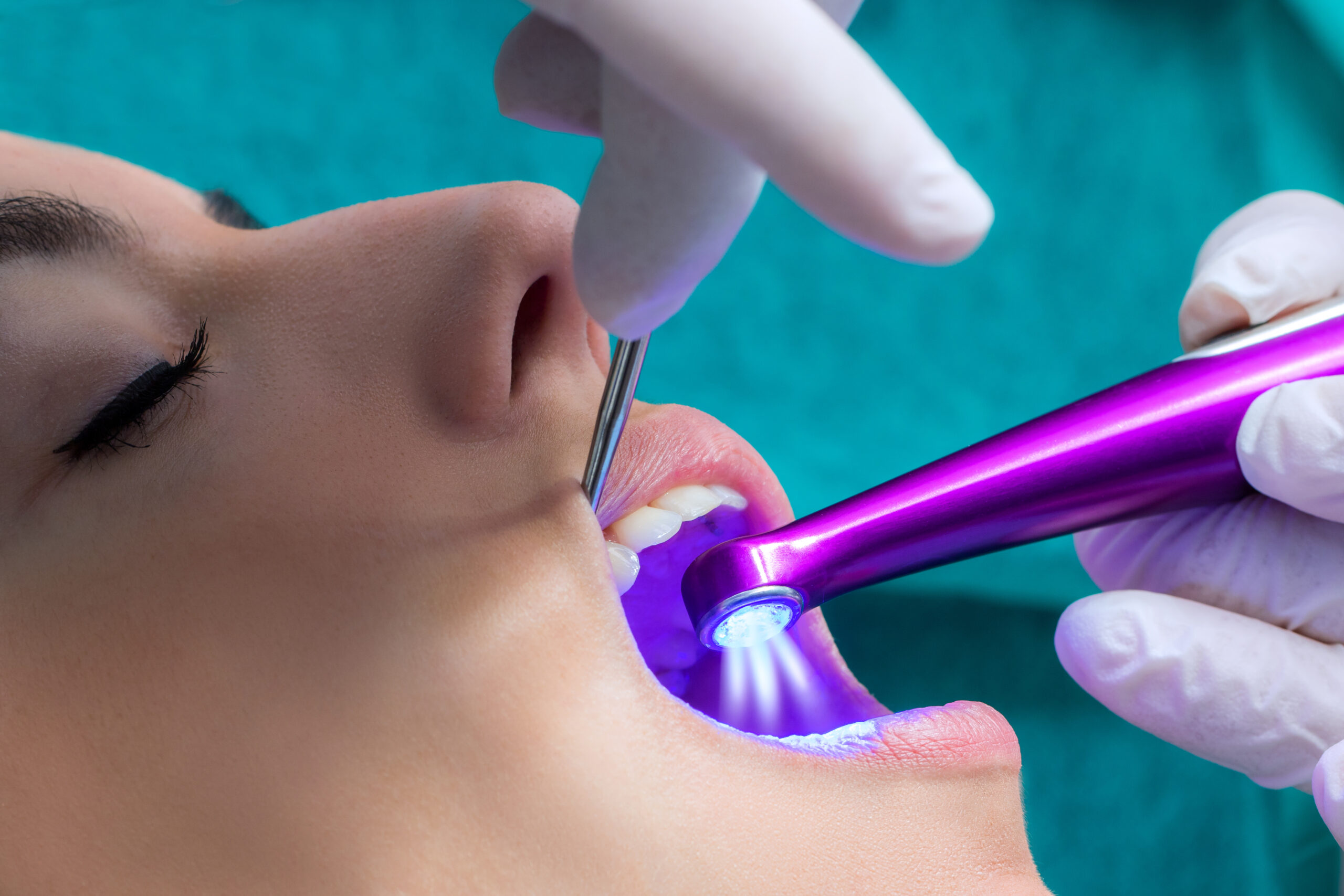 Dentist setting fissure sealant with led curing lamp on patient. Macro close up of hand working on female teeth with blue led curing light.